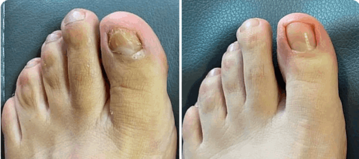 What is Orvelle Nail Fungus Pen – Orvelle