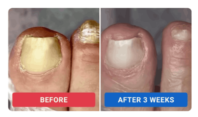 Orvelle Nail Fungus Pen review by Elena S. – Orvelle