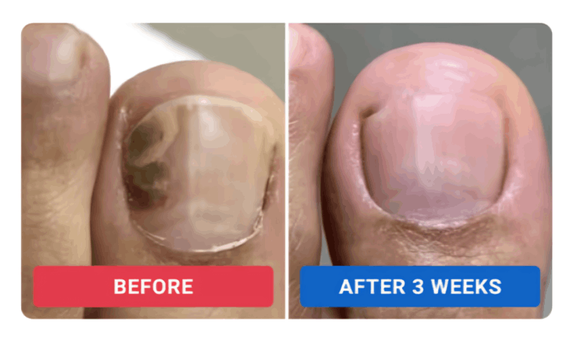Orvelle Nail Fungus Pen review by Rachel M. – Orvelle