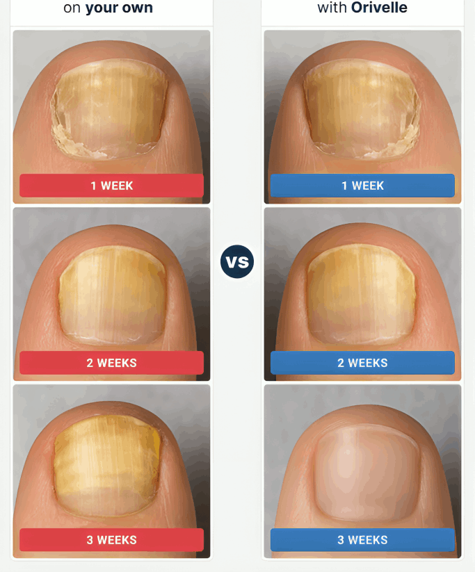 Orvelle Nail Fungus Pen before and after – Orvelle